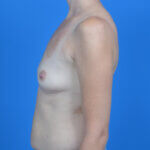 Breast augmentation 310ccsrx before lside