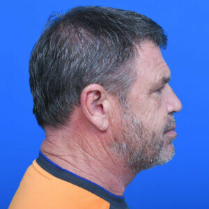 Male neck lift tzplasty right side after