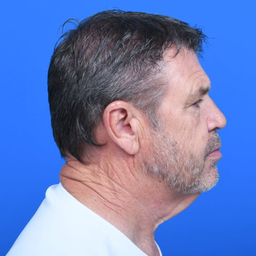 Male neck lift tzplasty right side before