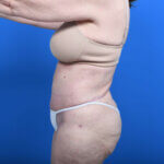 Abdominoplasty and liposuction after left side