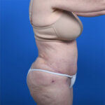 Abdominoplasty and liposuction after right side