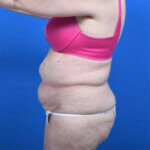 Abdominoplasty and liposuction before left side
