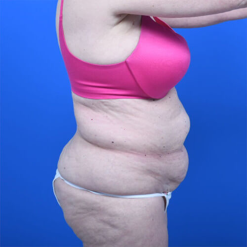 Abdominoplasty and liposuction before right side