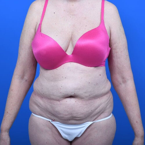 Abdominoplasty and liposuction before front