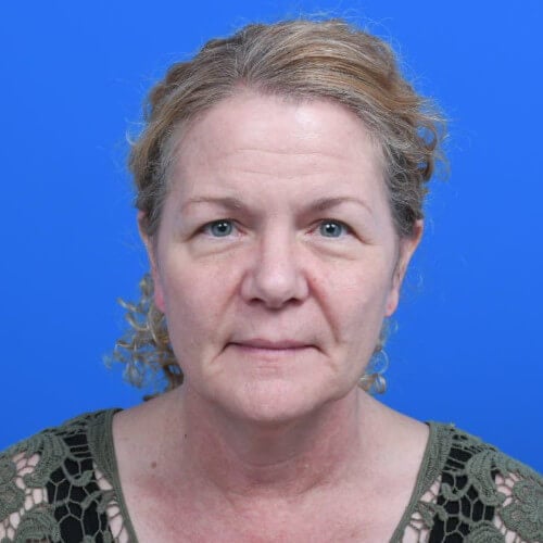 Facelift-necklift-before-front-0113