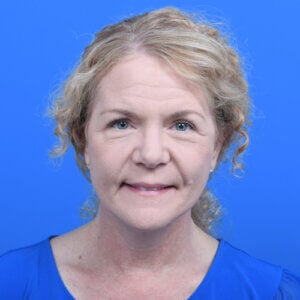 Facelift-necklift-after-front-0113