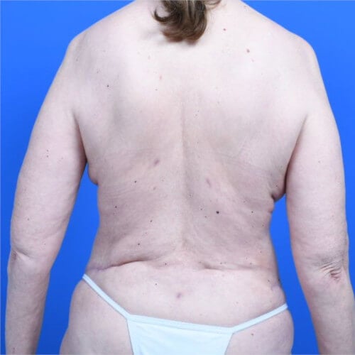 Liposuction back after