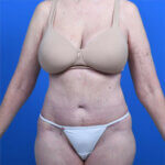 Liposuction front after