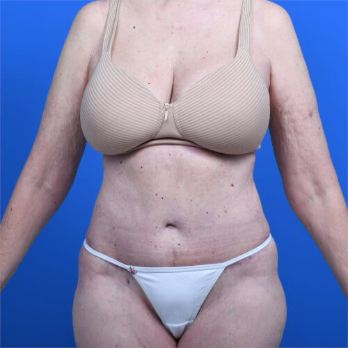Liposuction front after