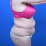 Liposuction right side before