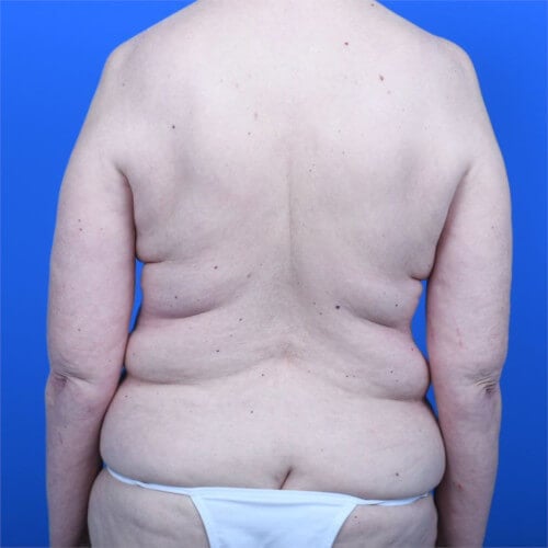 Liposuction back before