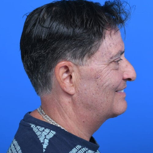 Male-necklift-tzplasty- rside-after
