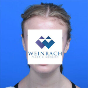 Otoplasty after front 14 years old