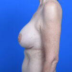 Breast revision galaflex left side after