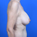 Breast revision galaflex right side after