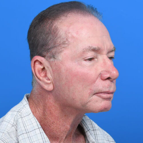Male neck lift right oblique after
