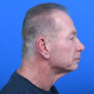 Male neck lift right side before