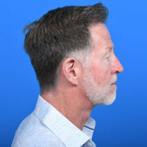 Male necklift right side after