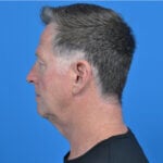 Male necklift left side before