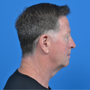 Male necklift right side before