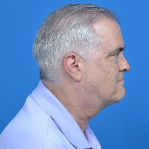 Male necklift tzplasty rside after