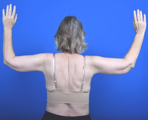 Arm lift after back