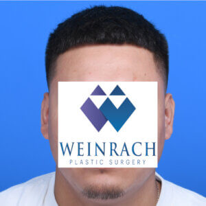 Otoplasty-after-front