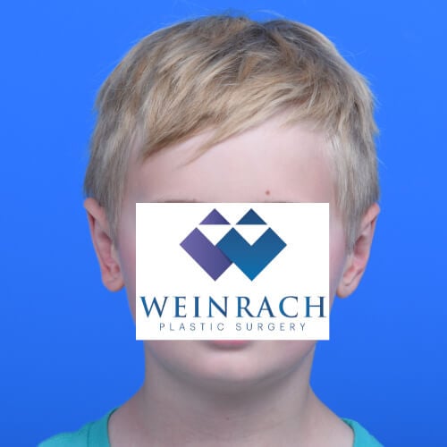 Otoplasty after front 9 year old
