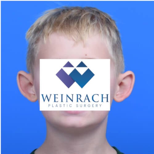 Otoplasty before front 9 year old