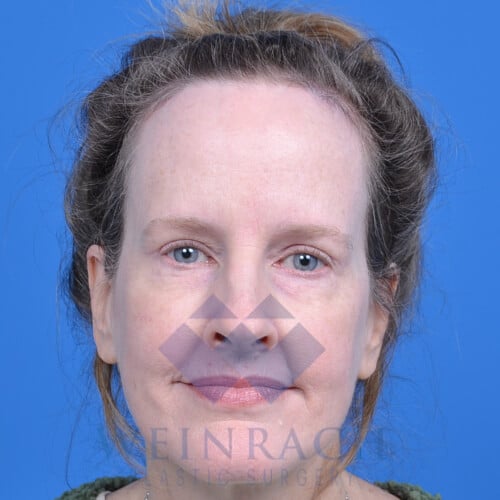 Upper and lower blepharoplasty after