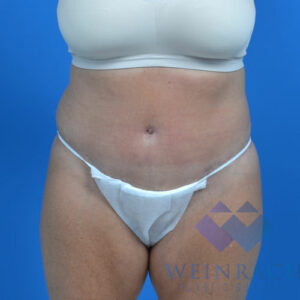 Tummy tuck after front