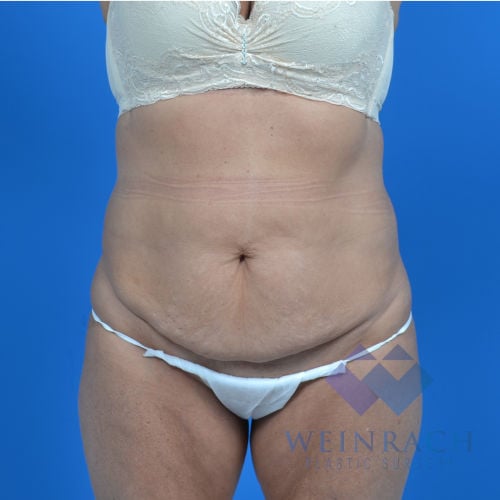Tummy tuck before fron