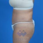 Tummy tuck after lside
