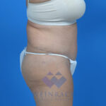 Tummy tuck after rside
