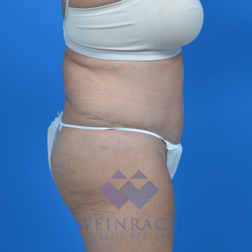 Tummy tuck after rside