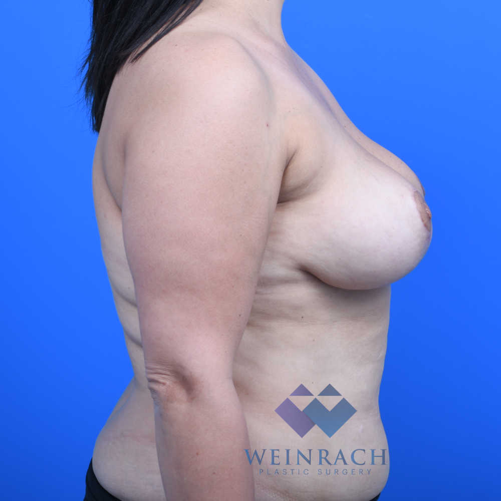 Breast reduction after right side