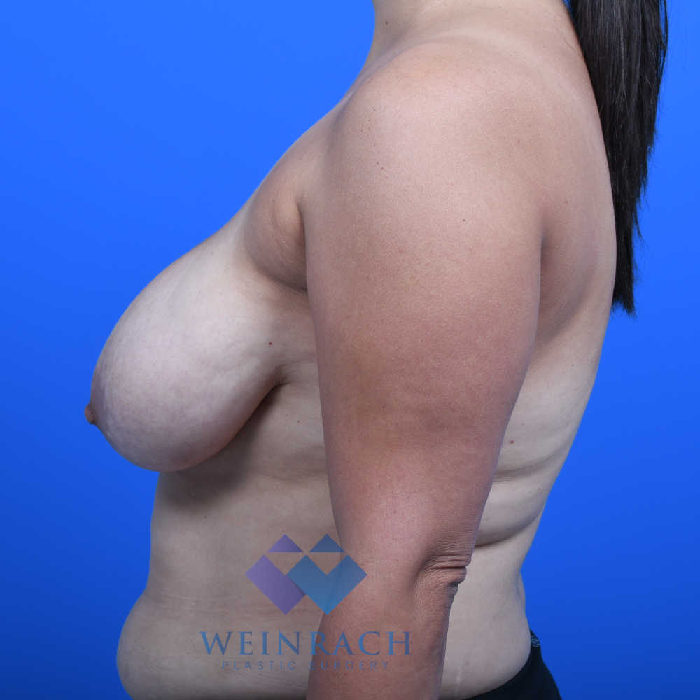 Breast reduction before left side