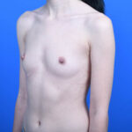 Breast augmentation before lo 260cc boost high profile