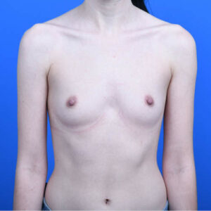 Breast augmentation before front 260cc boost high profile