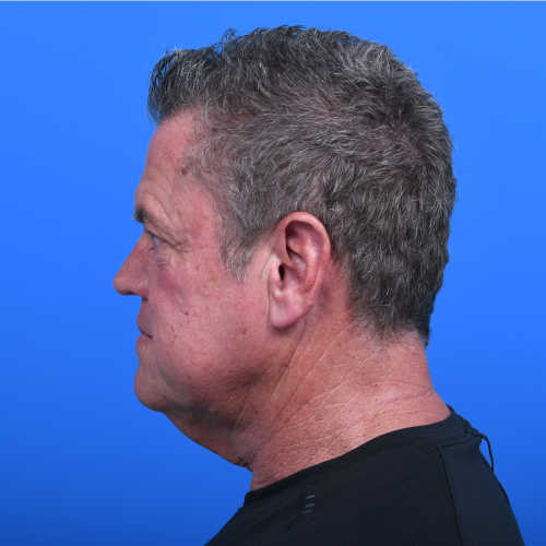 Male direct neck lift lside before