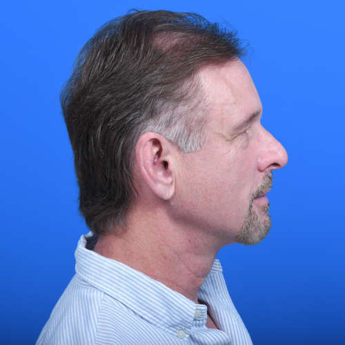 Tzplasty neck lift after right side