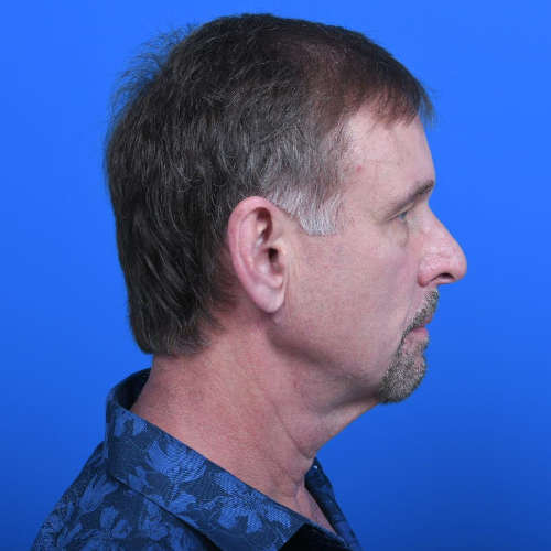Tzplasty neck lift before right side