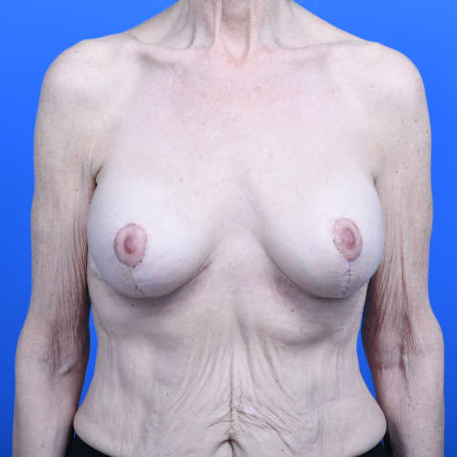 Breast lift implant exchange galaflex front after