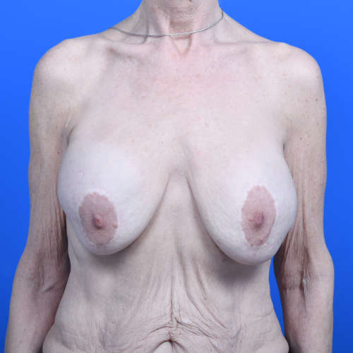 Breast lift implant exchange galaflex front before