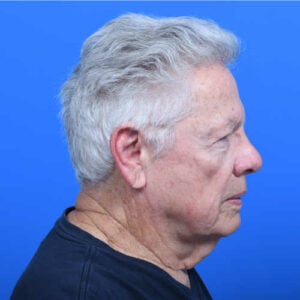 Neck lift tz plasty before rside