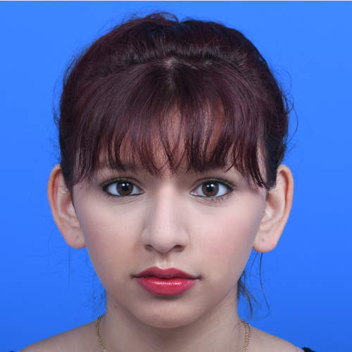 Otoplasty front before 14yo