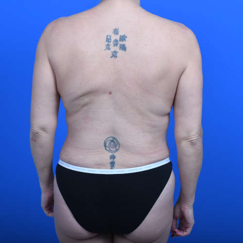 Liposuction flanks after