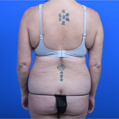Liposuction flanks before