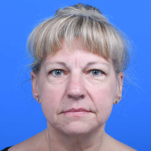 Otoplasty-front-after-1914