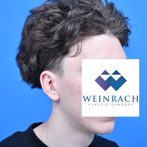 Otoplasty 16yo ro after